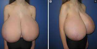 Chesty Moms on X: Amazing Macromastia ➡️ t.colgQlAkisvn  macromastia gigantomastia curvy xvideosِ Adultery nsfwtwt chubbygirl  sexbomb tiktokgirls bimbogirl megatitten tetasgrandes grosseins  chubby footfetish smallfeet ...