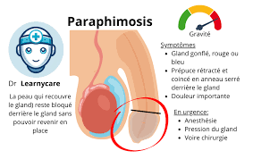 Image result for paraphimosis