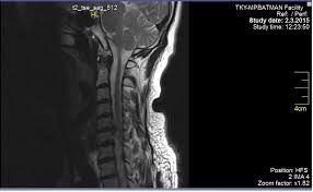 Boyun Fitigi Ameliyati Olan Var Mi Tecrubelerinizi Paylasir Misiniz 10 Sayfa