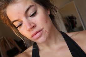 Kviser i ansiktsbehandlinger som prosedyren som er fremhevet ovenfor, fokuserer på ekstraksjon av overflødig ansiktsolje og smuss som tetter til huden. Tuva Willassen Huden Min Har Aldri Sett Verre Ut