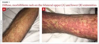Image result for Generalized Rash