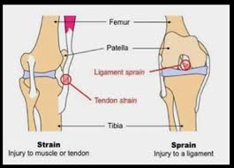 Check spelling or type a new query. Mcl Lcl Sprain Tear Blog Maywood Physical Therapy