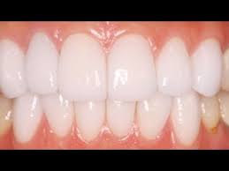 衝撃 お金をかけずに歯を白くする方法 即実践 驚くべき方法が凄すぎる youtube 歯を白く 歯 健康な歯