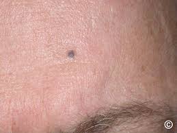 Image result for Blue Nevus