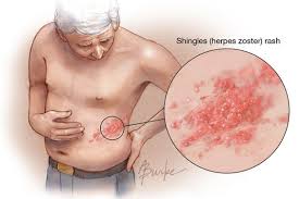 Image result for shingles