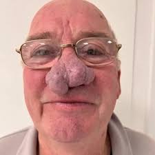 Scots grandad forced to pay to have huge nose growth removed and slams NHS  for lack of help