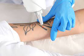 In order to remove those trapped ink particles, they must first be broken down into more manageable pieces. Tattoo Removal Premier Spa And Laser Center Newark De