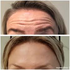 To understand this question, let is first answer the question: Pin En Nuveclinic Puerto Banus