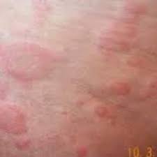 Connections Between Chronic Idiopathic Urticaria And Your Thyroid Chronic Hives Chronic Idiopathic Urticaria Idiopathic Urticaria