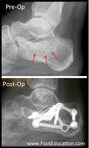 Image result for Calcaneus Compression Fracture