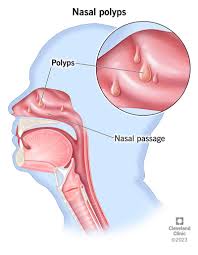 Nasal polyp treatment