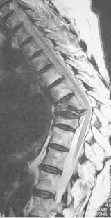 Osteoporose Knochenschwund Wirbelsaulenchirugie Klinikum Bad Bramstedt