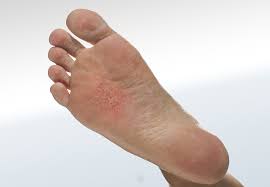 Image result for pompholyx soles of feet