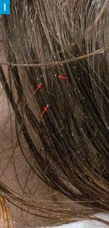 Several topical and systemic antifungal agents may not eradicate the disorder. Hair Breakage And Spontaneous Hair Loss In 2 Sailors Aboard An Aircraft Carrier Consultant360