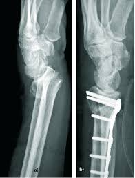 Knochenbruche Versorgen Im Alter Gelten Andere Regeln Doctors Today