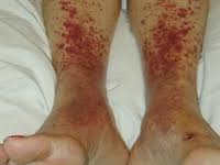 Red Rashes On The Lower Legs Clinical Advisor