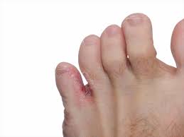 Any one of them could make an individual treatment plan and the patient will have to throw sponges and slippers. Signs And Symptoms Of Athlete S Foot