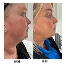 🌟🌟🌟FAT DISSOLVING 🌟🌟🌟 🔥🔥REMOVE FAT FOR GOOD🔥🔥 🌟🌟DOUBLE CHINS  GONE🌟🌟 ⭐️Fat dissolving is amazing for stubborn pockets of fat that is  hard to remove through diet and exercise. ⭐️One of the safest