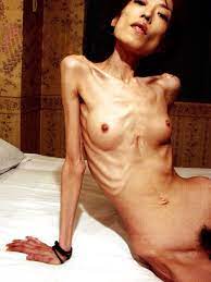 Anorexic nude women