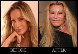 These include eye drops, pills and emerging home remedies like medical mariju. Top 9 Worst Celebrity Plastic Surgeries Bad Celebrity Plastic Surgery Celebrity Plastic Surgery Cosmetic Surgery