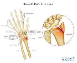 Image result for Growth Plate