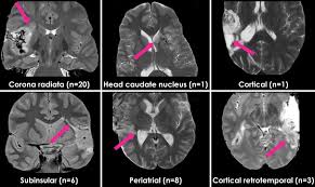 Stay connected to your athletes through upmc lemieux sports' complex customized mobile app built just for you. Operculoinsular Cortectomy For Refractory Epilepsy Part 2 Is It Safe In Journal Of Neurosurgery Volume 133 Issue 4 2019