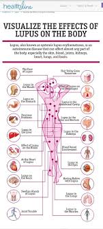 Lupus Uctd Diy Acne Treatment Autoimmune Disease Lupus Facts