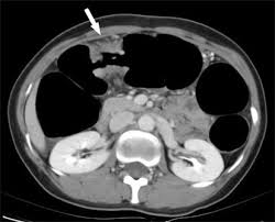 But some cancer survivors develop a new, unrelated cancer later. A 39 Year Old Woman With Mid Transverse Colon Cancer Axial Ct Scan Download Scientific Diagram