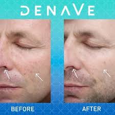 Check out these results from our new DenaVe laser 🤩, DenaVe is the gold  standard in treating rosacea, spider veins, capillaries, hyperpigmentation,  birthmarks, vascular lesions, and more! , ☎️ ...