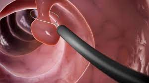 Colonoscopy can spot small colon cancers while they are treatable and before they have spread to other parts of the body. 10 Colonoscopy Myths Debunked Gastroenterologist San Antonio
