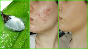 How To Use Aloe Vera On Face For Clear Spotless Skin How To Exfoliate With Aloe Vera For Smooth Skin Youtube Aloe vera is probably one of the oldest plants that is still respected and widely used now days.