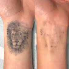 Overall, to remove a tattoo without lasers, you can head to tattoo vanish; Laser Tattoo Removal Vancouver Toronto Adrenaline Studios