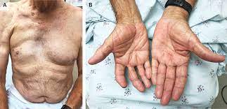 Check spelling or type a new query. Poland Syndrome Nejm