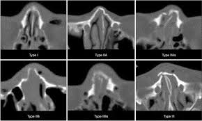 Benumof and hagberg's airway management, 2013. Classification Of Nasal Bone Fracture Each Types Classification Download Scientific Diagram