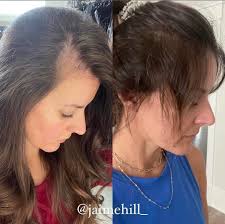 Have you experienced hair loss recently? Per this article in The Atlantic  you are not alone. One of the leading causes of hair loss is STRESS! Who  has not been under an