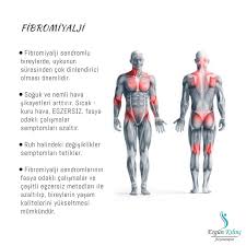 Fibromiyalji için seçilecek olan egzersiz yöntemine esneme egzersizleri ile başlanmalı ve bu egzersiz seçiminin yanı sıra hareket aralığı egzersizi de önemli bir husustur. Uzm Fzt Ergun Kilinc Fibromiyalji Nedir Kronik Agri Ve Yorgunluk Sendromu Olarak Bilinen Fibromiyalji Sendromu Kaslarda Yaygin Agri Ve Hassasiyet Uyku Bozuklugu Yorgunluk Halsizlik Ve Sabah Tutuklugu Ile Kendini Gosterir
