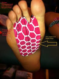 Www Kttape Com View Topic Mortons Neuroma Morton S Neuroma Neuroma Kinesiology Taping
