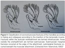 Image result for Coronoid Process Fracture