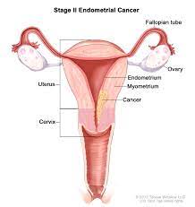 By stage iv, the cancer has grown to involve nearby organs, such as the bladder, or has spread to distant areas of the body. Endometrial Cancer Treatment Pdq Patient Version National Cancer Institute