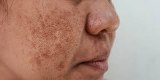 Image result for Melasma