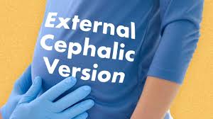Image result for External Cephalic Version