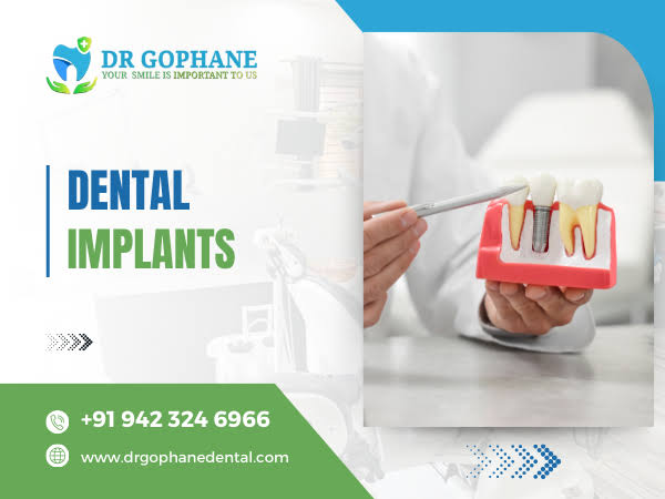 Dental Implants In Yavatmal product image