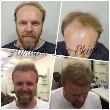 Sizler için en iyi saç ekimi merkezi listesi hazırladık. Avrupa Sac Ekimi Clinic In Turkey Treatment Cost And Verified Reviews Bookimed