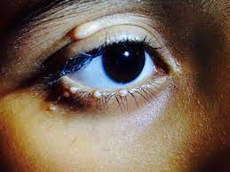 A chalazion happens when a tiny part of your. There S A Bump On My Eyelid Molluscum Contagiosum Eyedolatry