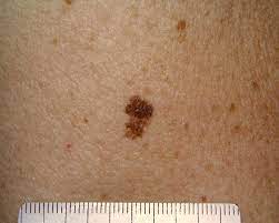 Melanoma can look different in children Skin Cancer Epidemic