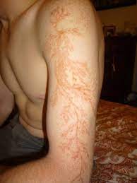 Scar was my 2nd favorite fma character after maes hughes. Here S What A Lightning Strike Can Do To Your Skin