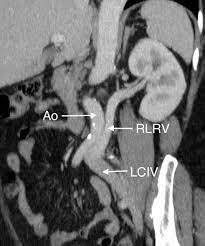 Retroaortic Left Renal Vein Rlrv Draining Into The Left Common Iliac Vein A Rare Variant And Its Clinical Implication Bmj Case Reports