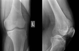 We did not find results for: Arthroscopic Management Of A Posterior Femoral Condyle Hoffa Fracture Surgical Technique Arthroscopy Techniques