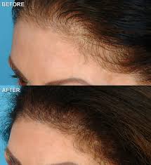 Best tips on how to regain hair naturally: Video Proven Method On How To Naturally Regrow Hair On Bald Head Within A Week Tellforce Blog