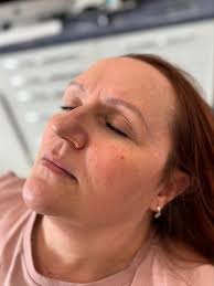 How beautiful does this patient's skin look after our Fire & Ice facial?!  The perfect facial for that instant glow 🫧 This treatment leaves skin  clearer, brighter and tighter without any downtime